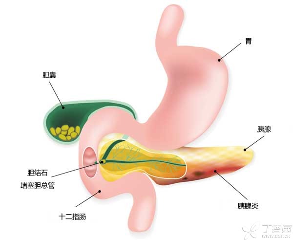 胆结石插图2-600.jpg